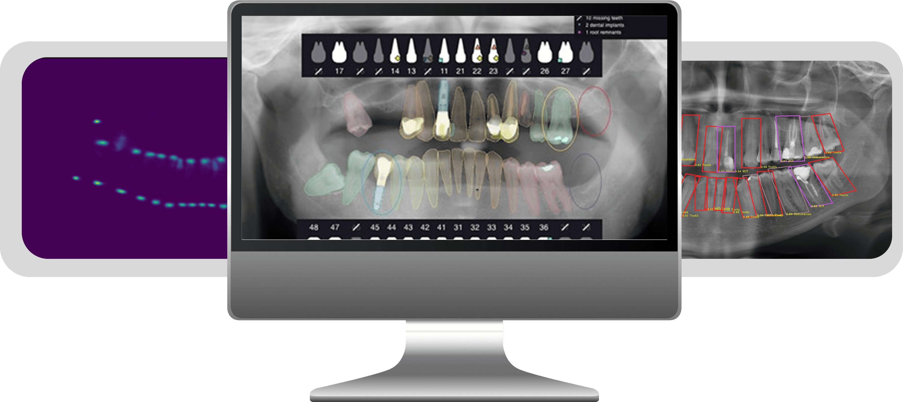 Intelligent Diagnosis for Dental Panoramic X-Rays - Smarter, Faster, More Accurate